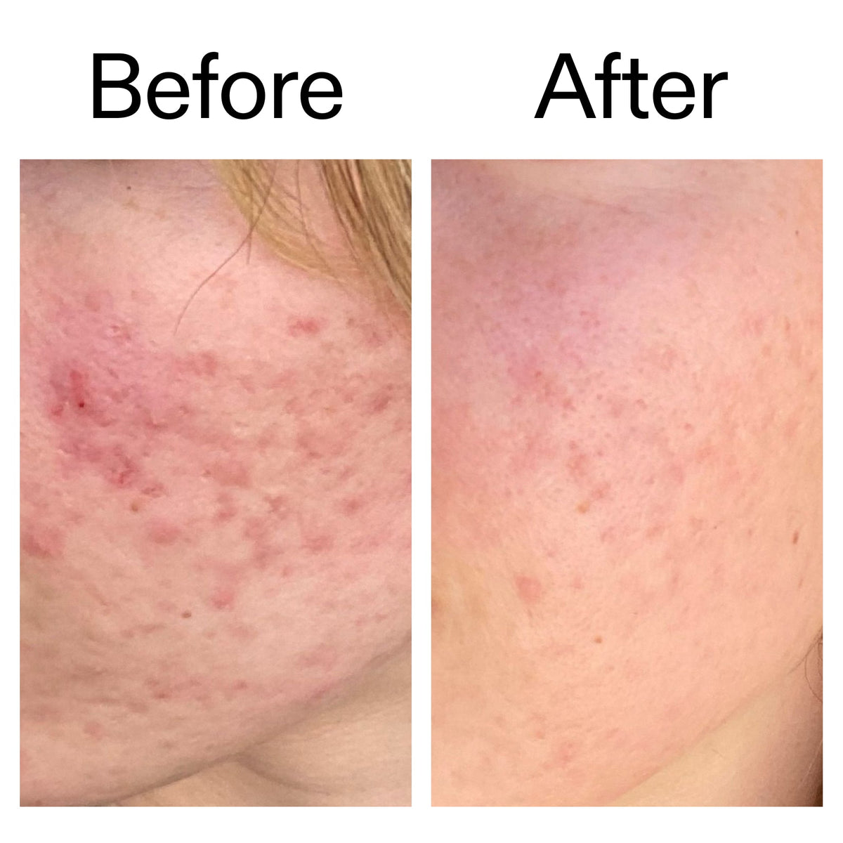 10-azelaic-acid-serum-for-redness-relief-u9 Azealic_Acid_Serum_B_A_Ppage_2000_x_2000.jpg
