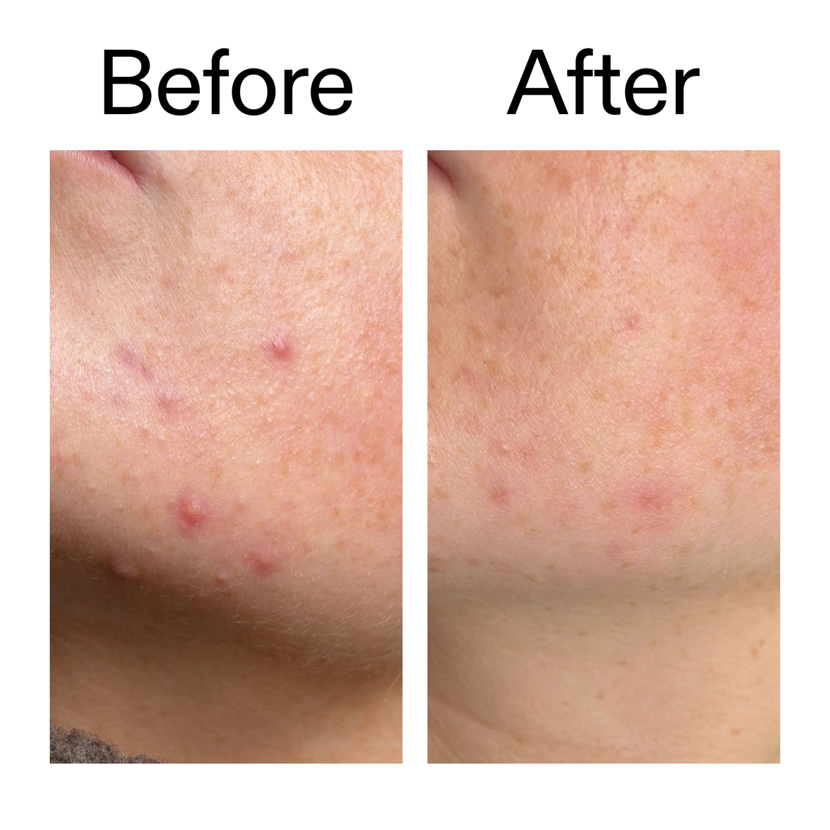 10-azelaic-acid-serum-for-redness-relief-u9 B_A_1_PPAGE.png