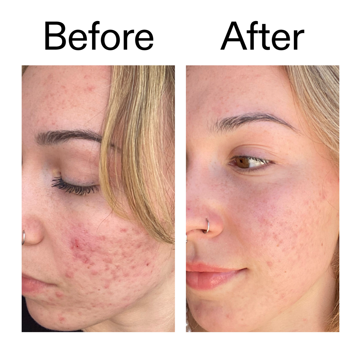 10-azelaic-acid-serum-for-redness-relief-u9 B_A_2_PPAGE.png