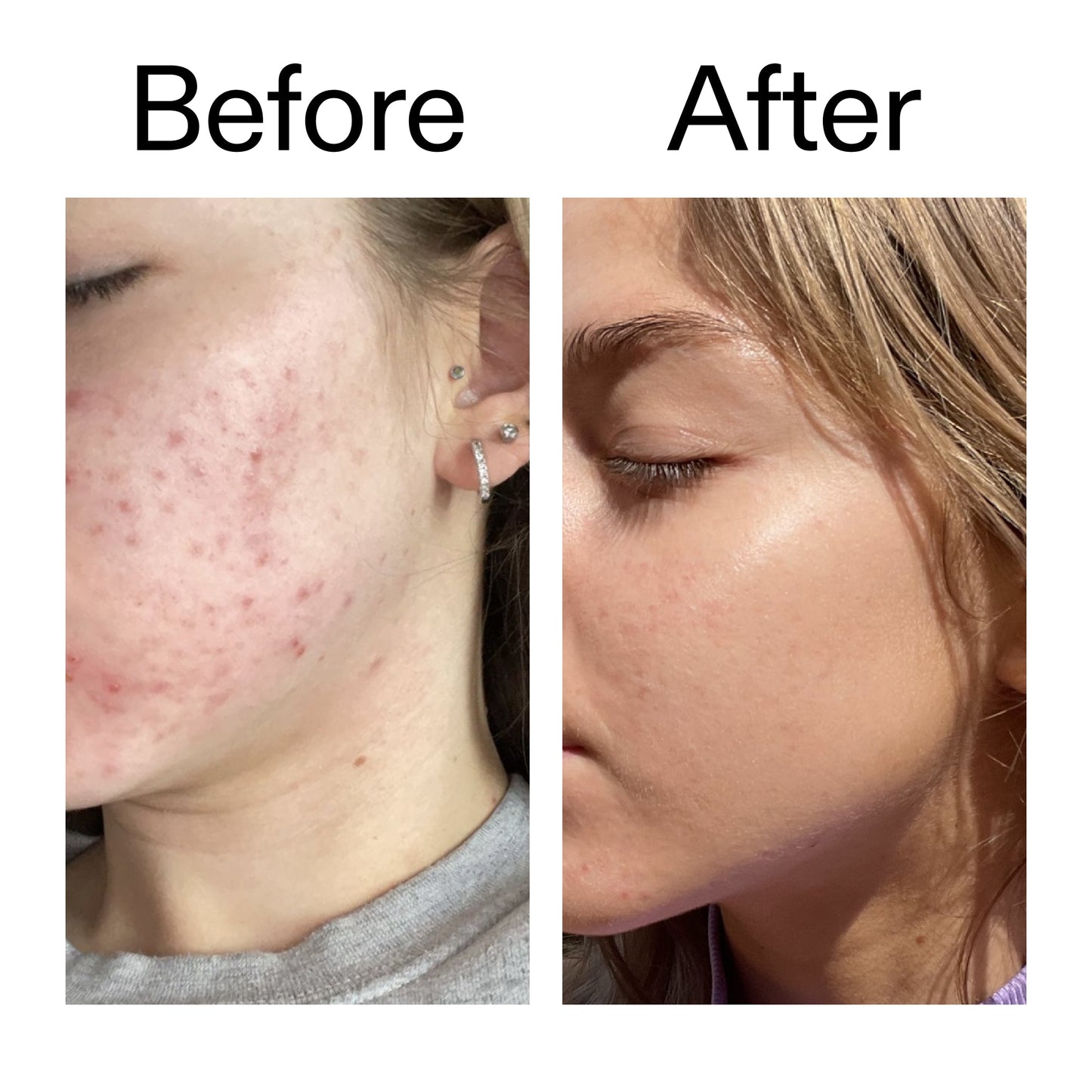 beta-hydroxy-acid-bha-serum-r0 Beta_Hydroxy_Acid_Serum_Before_After_2000x2000_96fda3e5-938d-49ef-bcf2-a0fa6ece4e2c.jpg