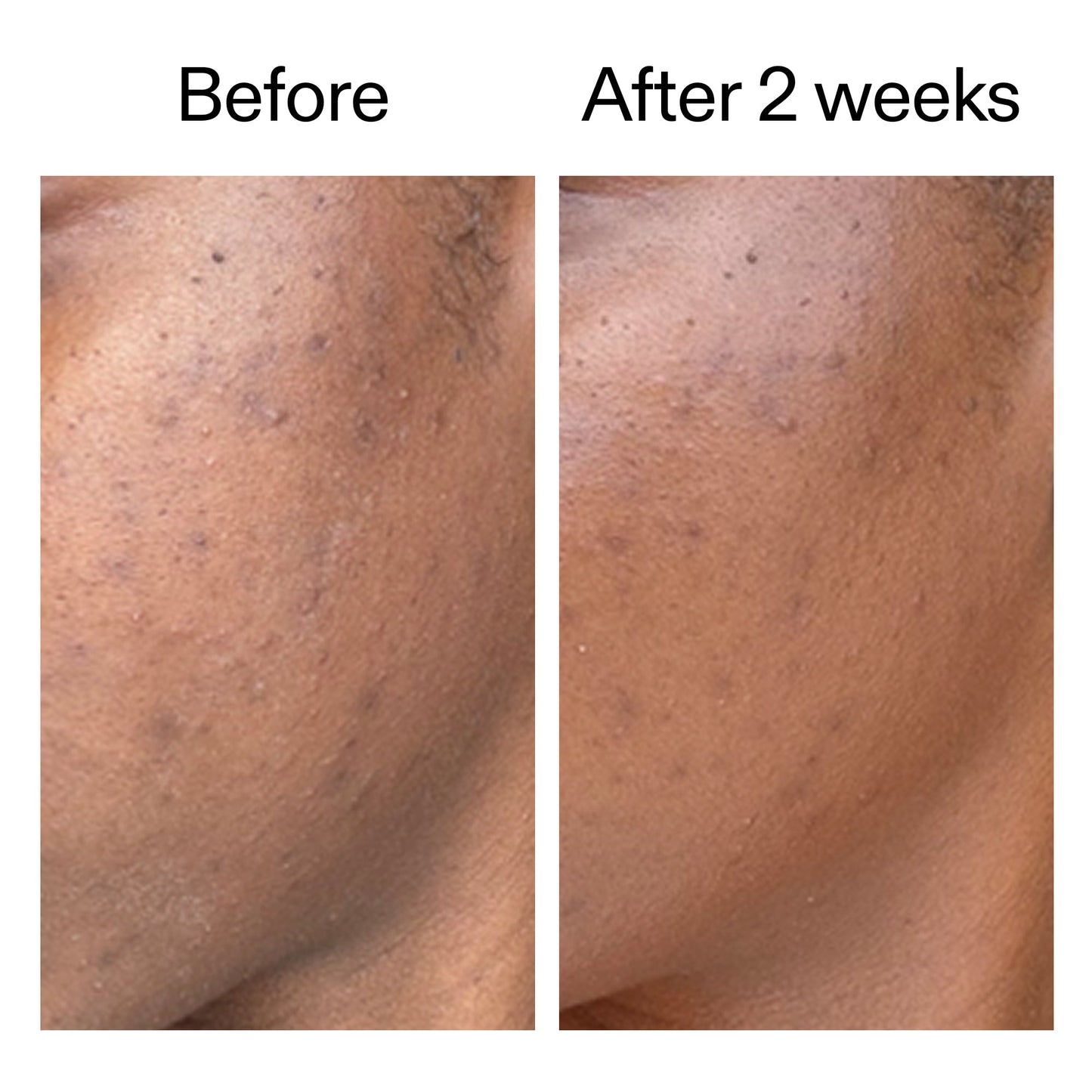 360-acne-clearing-serum-x2 DIOICB_A2000x2000.jpg