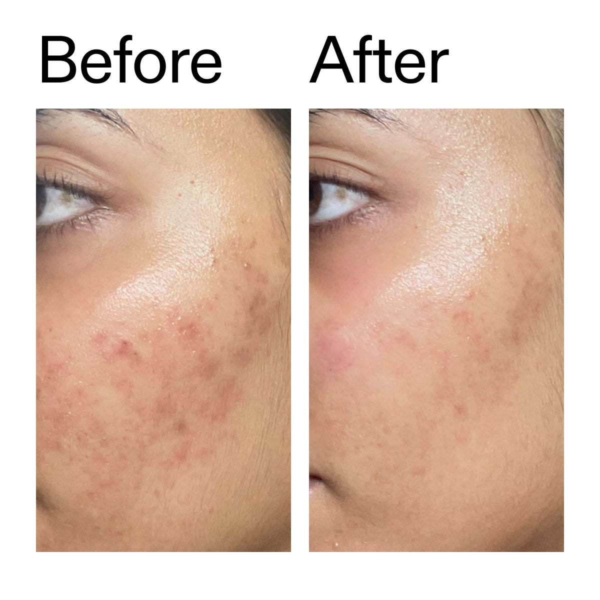 ectoin-hydro-barrier-serum-i5 Ectoin_Hydro-barrier_Serum__Before_After_2000x2000_34261920-d004-48d0-9c7b-8e1c15971bfd.jpg