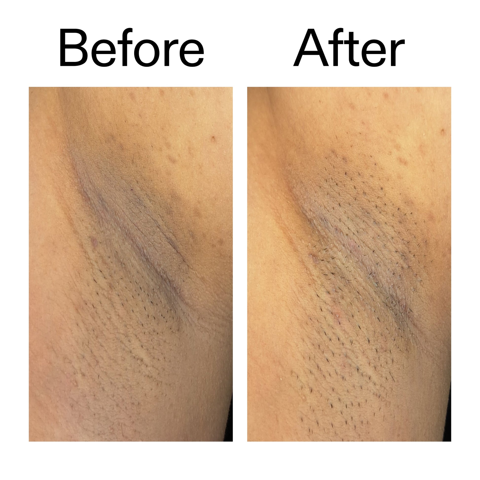 glycolic-acid-exfoliating-body-stick-n1 Glycolic_Acid_Exfoliating_Body_Stick_Before_After_V3_2000x2000_ea919cd9-1439-4a46-82a0-76200eb5bb42.jpg