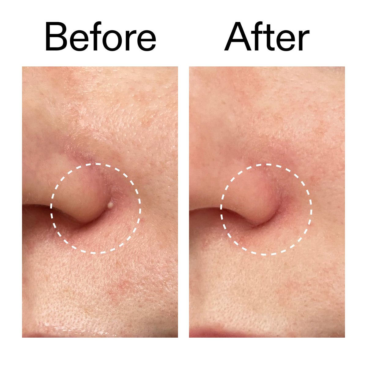 hydrocolloid-invisible-pimple-patches-pack-of-44-n8 Hydrocolloid_Invisible_Pimple_Patches_Before_After_2000x2000_b02aa37b-c78a-4682-91de-9135af5bb7df.jpg