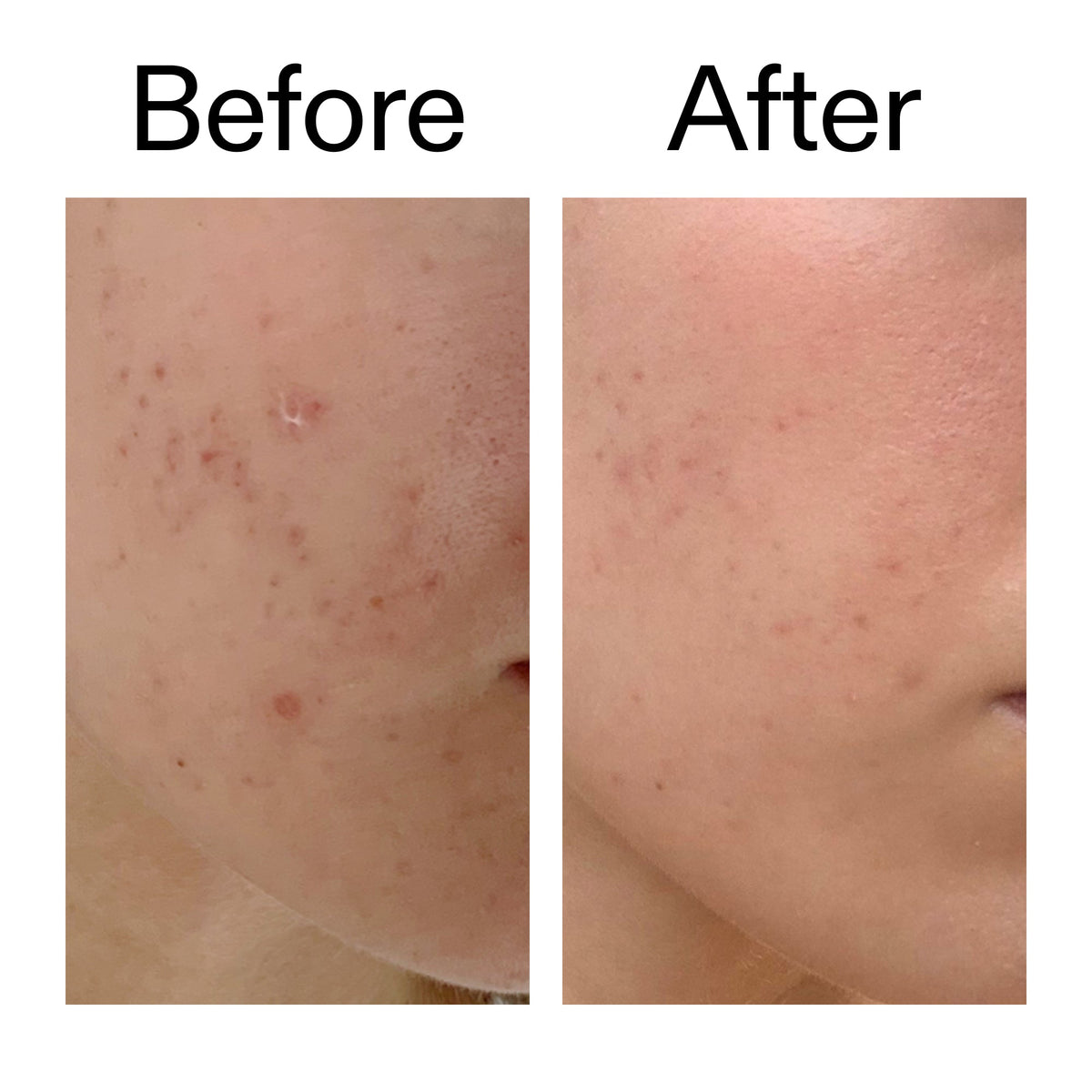 mandelic-acid-treatment-m6 Mandelic_Acid_Treatment_Before_After_2000x2000_4885ac6e-c5d7-4279-a72a-1417af7dce35.jpg