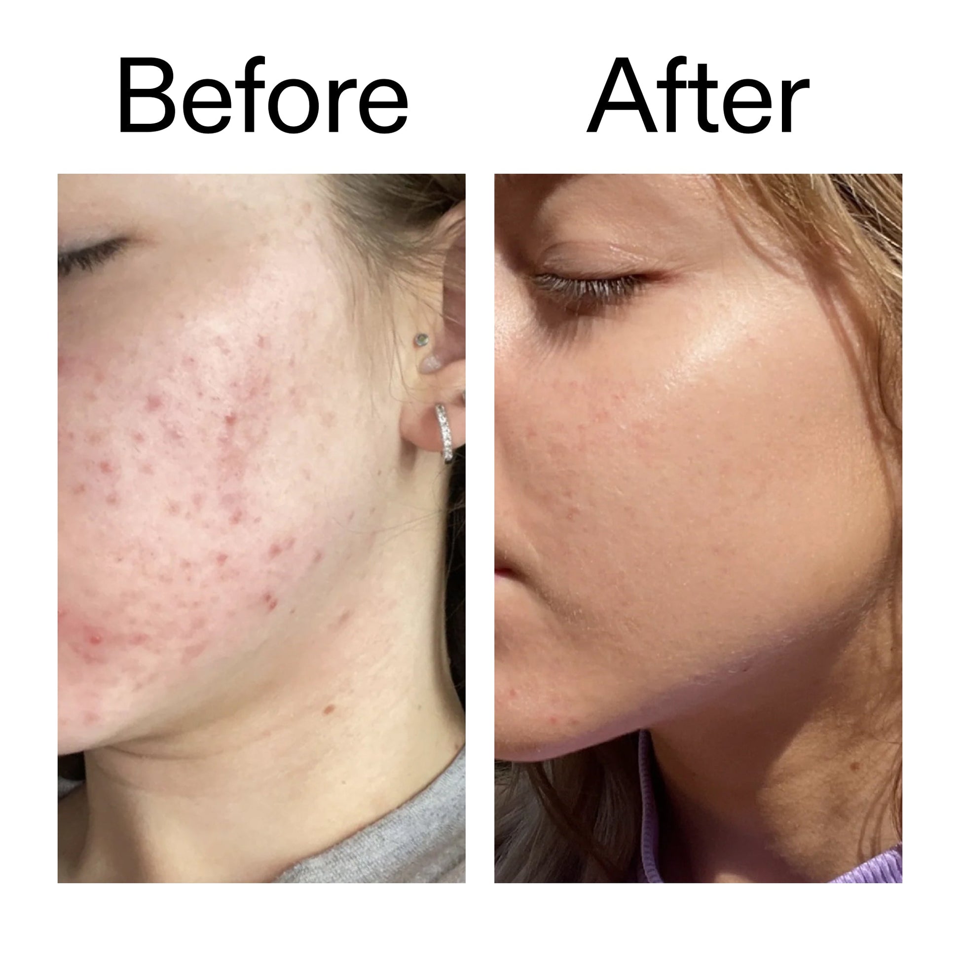 10-niacinamide-serum-a9 Niacinamide_Serum_Before_After_2000x2000_bde32455-9e7d-448e-b053-bef41504f0a9.jpg