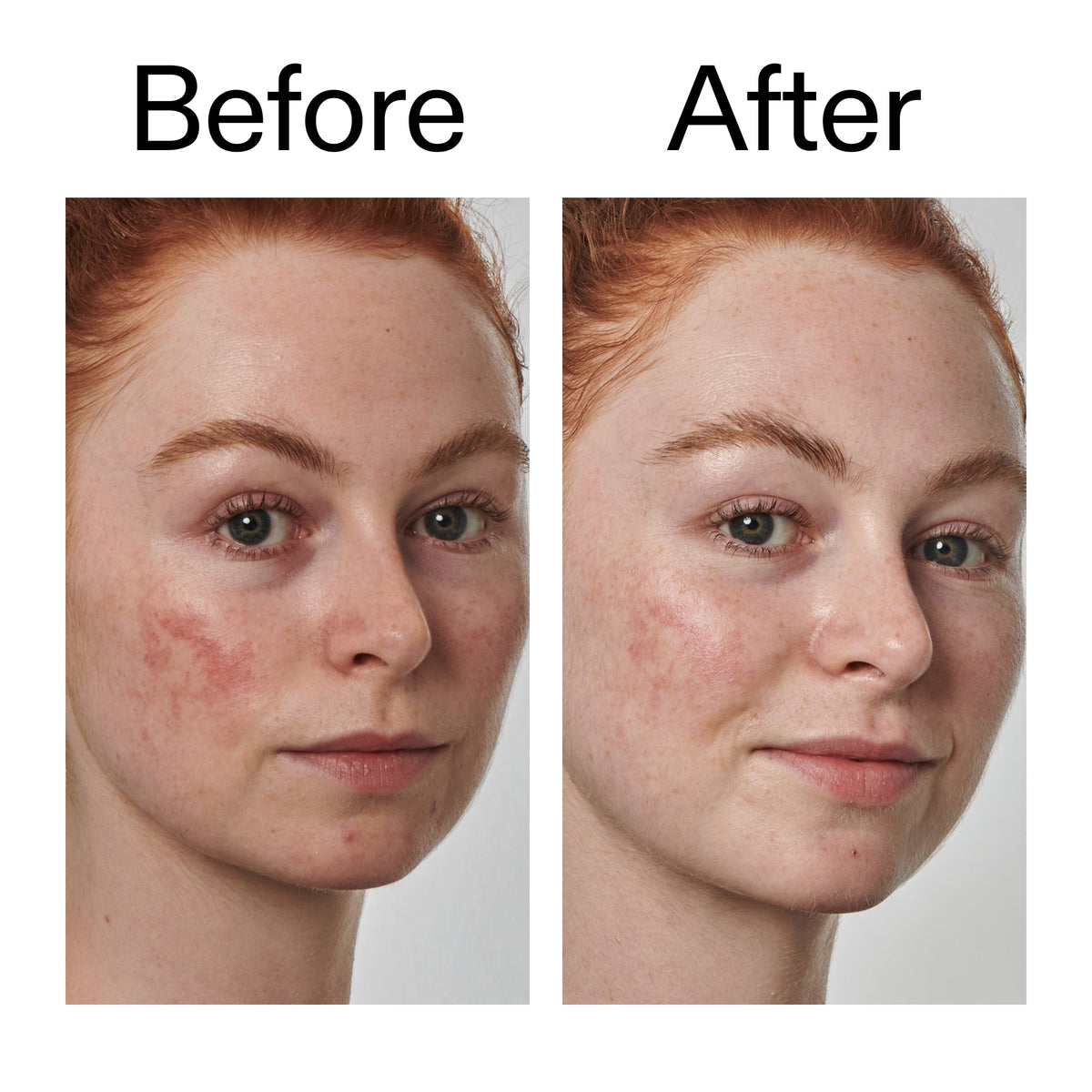 10-azelaic-acid-serum-for-redness-relief-u9 Redness_Relief_Serum_Before_After_2000x2000_3334dc9a-cce9-4e00-8aec-7ad89ca051f2.jpg