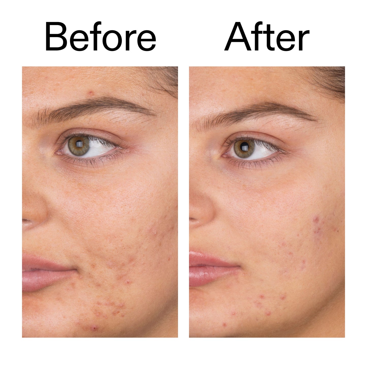salicylic-acid-cleanser-duo-x0 Salicylic_Acid_Cleanser_-_150ml_Before_After_2000x2000_e7230494-853f-4b07-82b1-27669104c995.jpg
