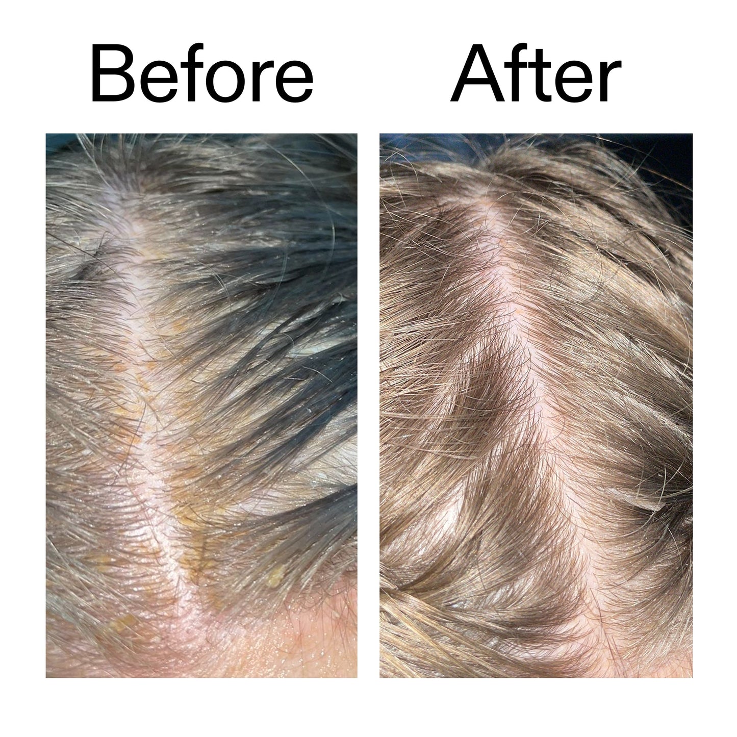 salicylic-acid-exfoliating-scalp-treatment-u1 Salicylic_Acid_Exfoliating_Scalp_Treatment_Before_After_2000x2000_e572a30f-057c-4a48-823b-1c09dc97f8d0.jpg
