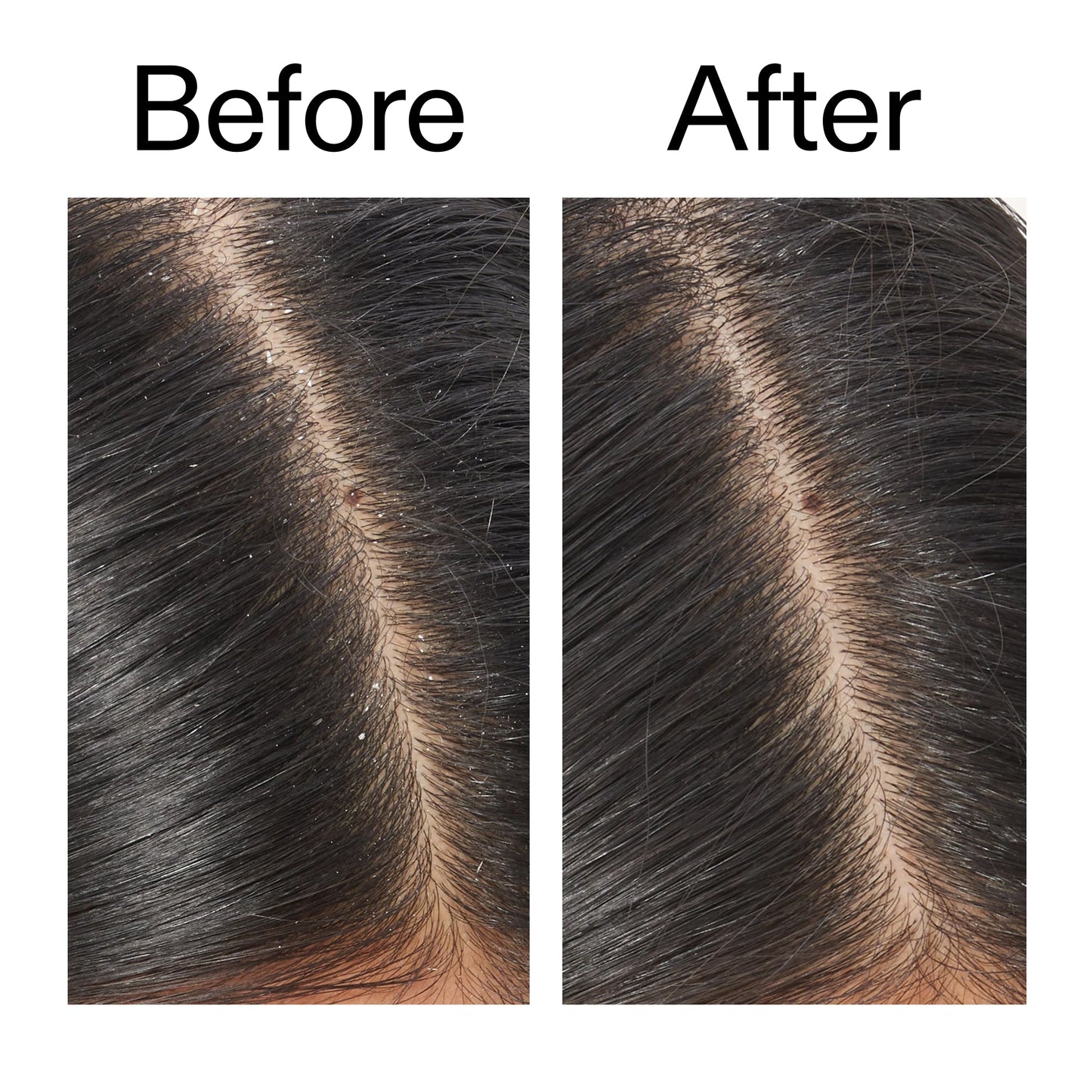 salicylic-acid-exfoliating-scalp-treatment-u1 Salicylic_Acid_Exfoliating_Scalp_Treatment_Before_After_V2_2000x2000_02bd61ad-42bf-490b-b3e3-7e04b2e8a673.jpg