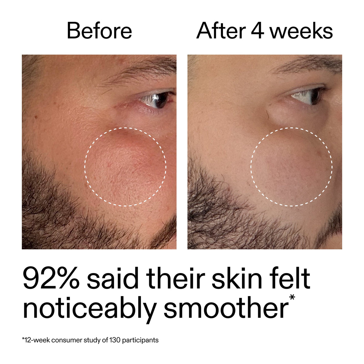 starter-retinol-serum-q2 StarterRetinol_BeforeAfter_Claim3_2000x2000_6ceab106-e0ee-4ed4-ba62-41bc39538038.jpg
