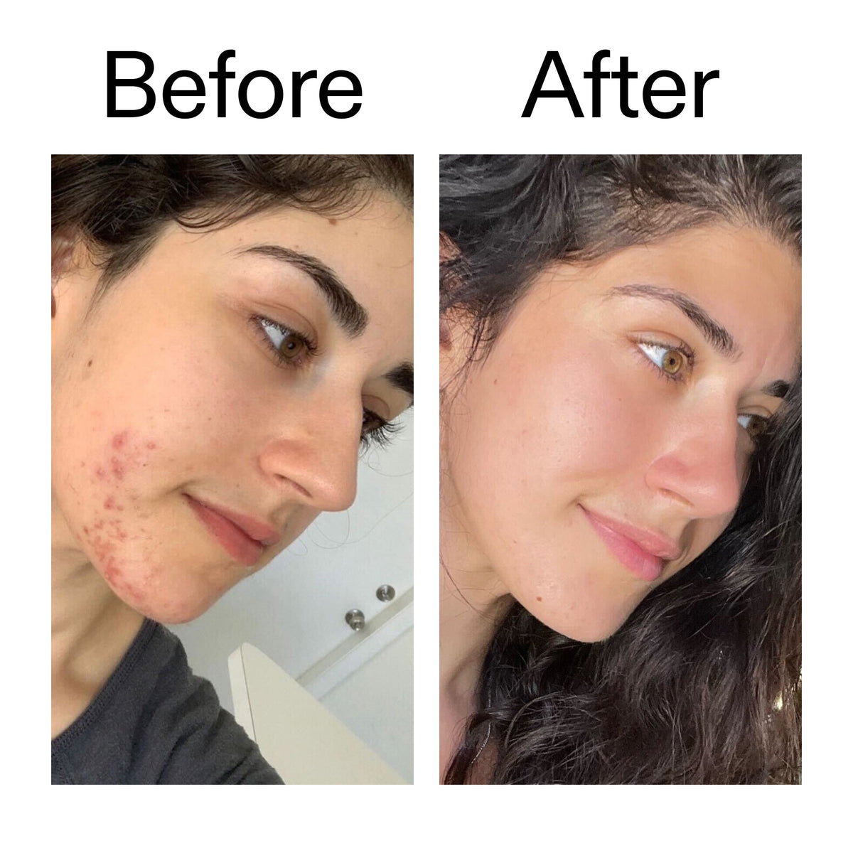 succinic-acid-acne-treatment-b0 Succinic_Acid_Treatment_Before_After_2000x2000_6a5f0054-2f58-4433-9314-0dc72c9bdd3b.jpg