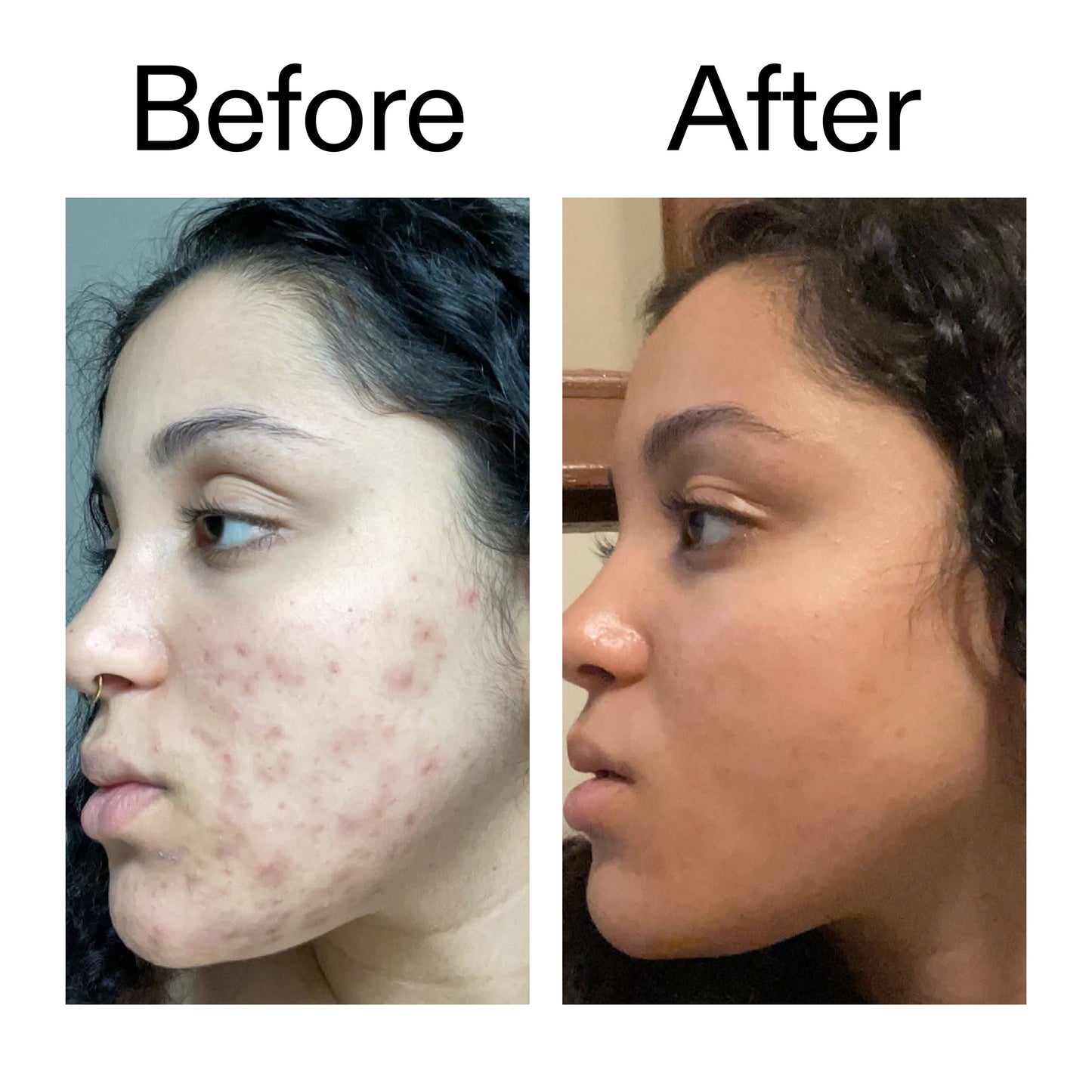 tranexamic-acid-serum-q4 Tranexamic_Acid_Serum_Before_After_2000x2000_98ebc8be-77b0-4843-8a22-90790ebe918b.jpg